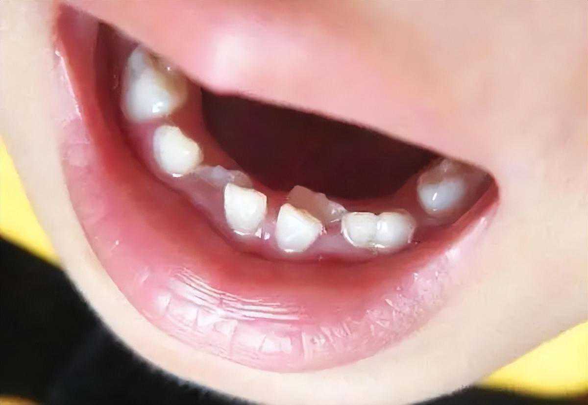 旧牙未脱落新牙就萌出，当孩子长出“双排牙”，家长的做法很重要