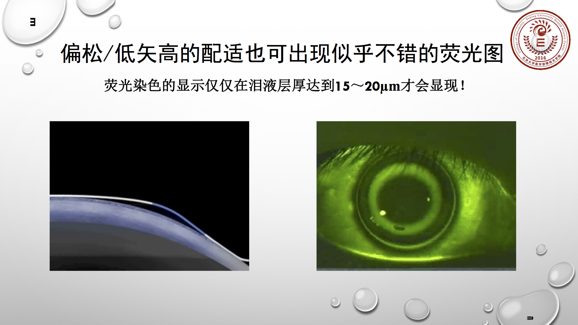 王凯副教授：角膜塑形镜的泪液层控制（露晰得公开课第51期）